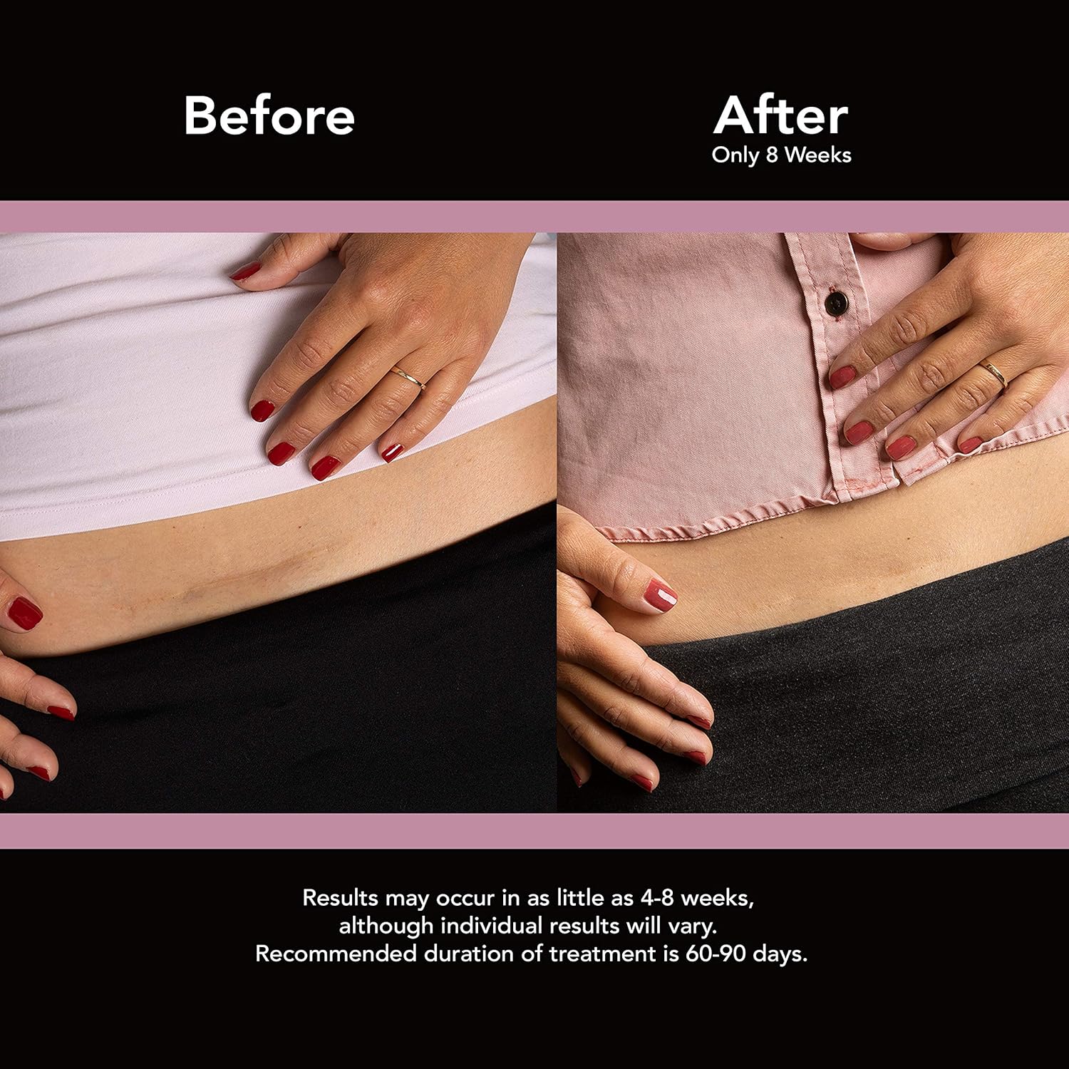 ScarAway Silicone Scar Sheets for C-Sections, Reusable Sheets (1.5” x 7”) for Hypertrophic and Keloid Scars from Injury, Burn, Surgery and more, 4 Sheets (895384002159): Health & Personal Care