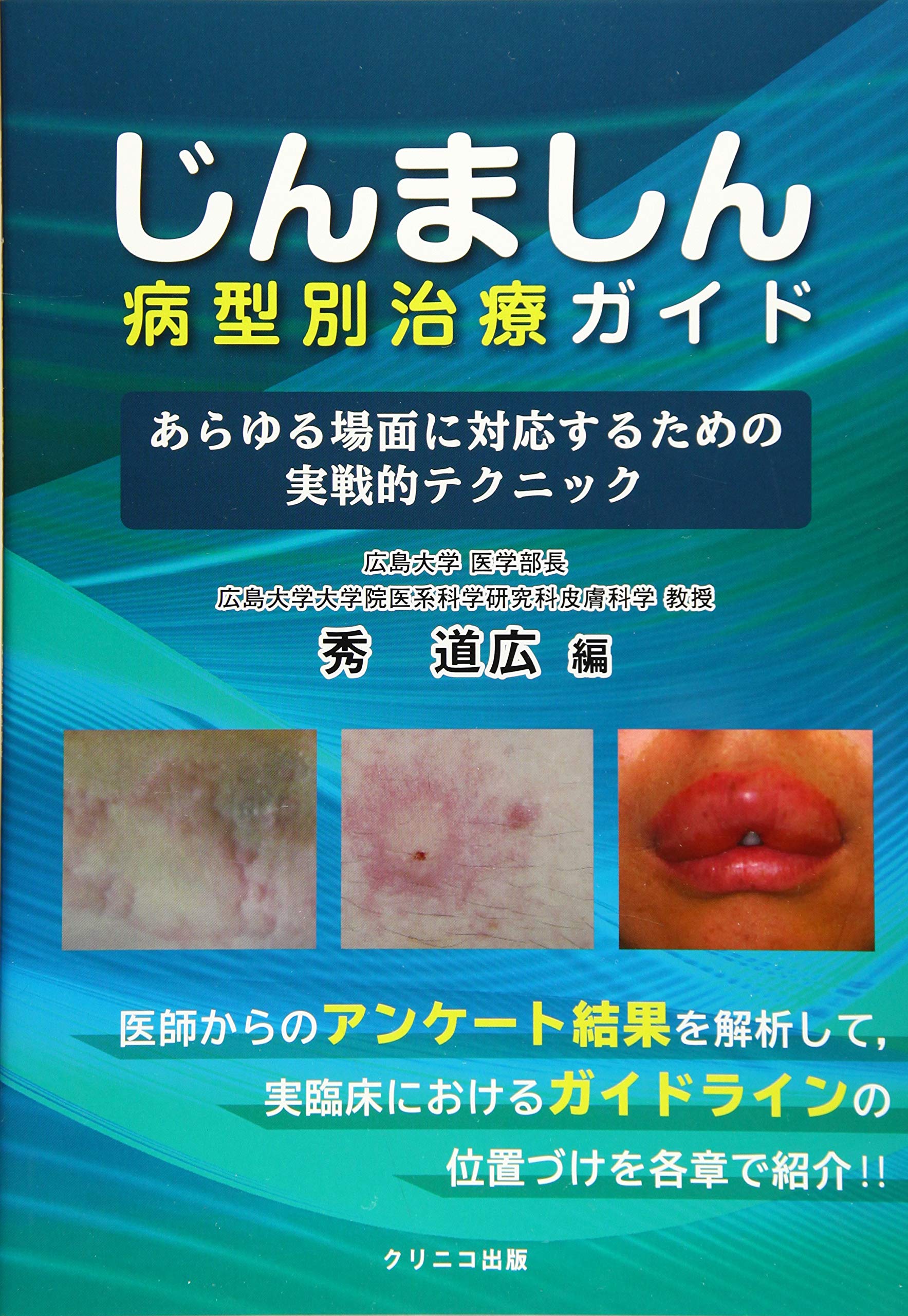 じんましん病型別治療ガイド あらゆる場面に対応するための実戦的テクニック 秀道広 中原剛士 猪又直子 福永淳 高萩俊輔 秀道広 中原剛士 猪又直子 福永淳 高萩俊輔 本 通販 Amazon