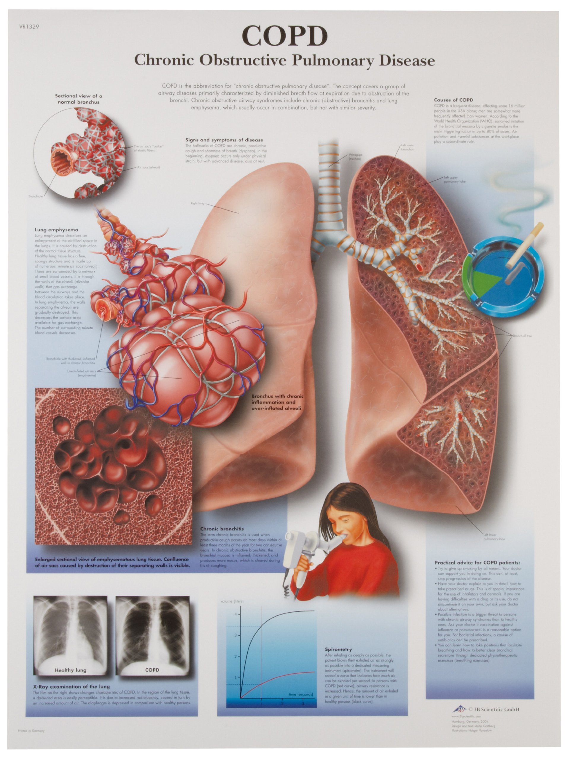 3B Scientific Human Anatomy - Chronic Obstructive Pulmonary Disease Chart, Paper Version