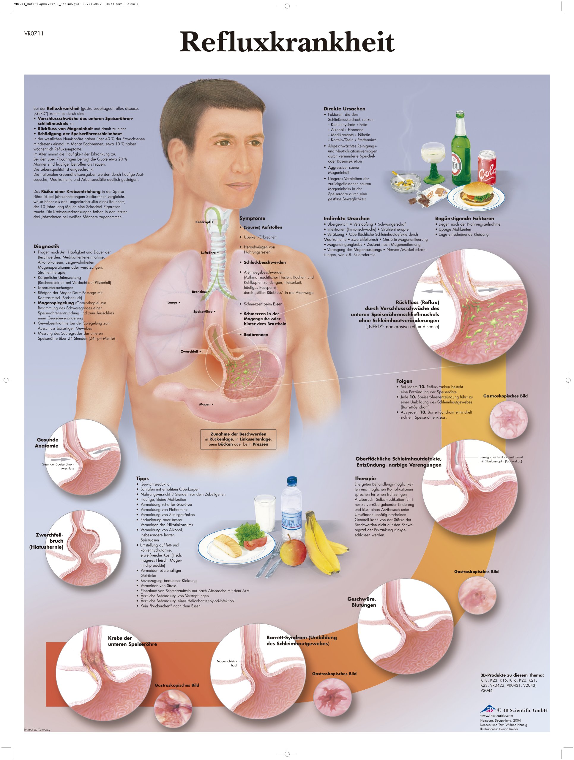 3B Scientific Laminated Chart, Reflux Disease