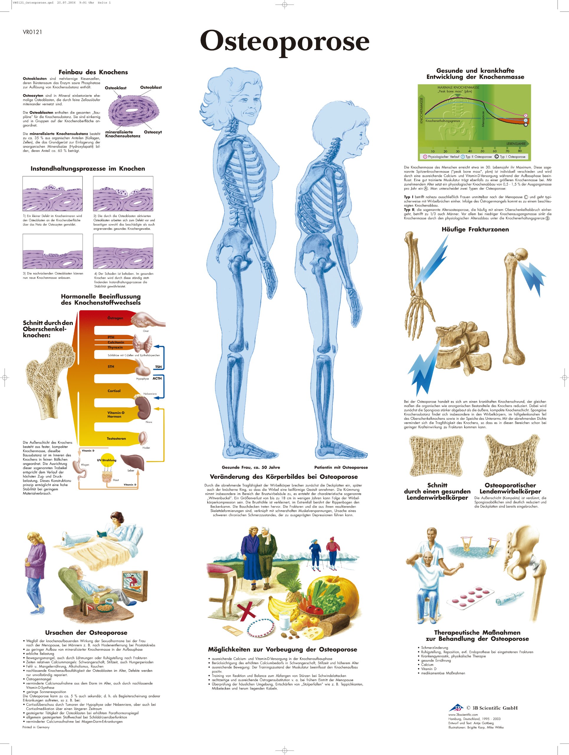 3B Scientific VR0121L Laminated Educational Chart - Osteoporosis