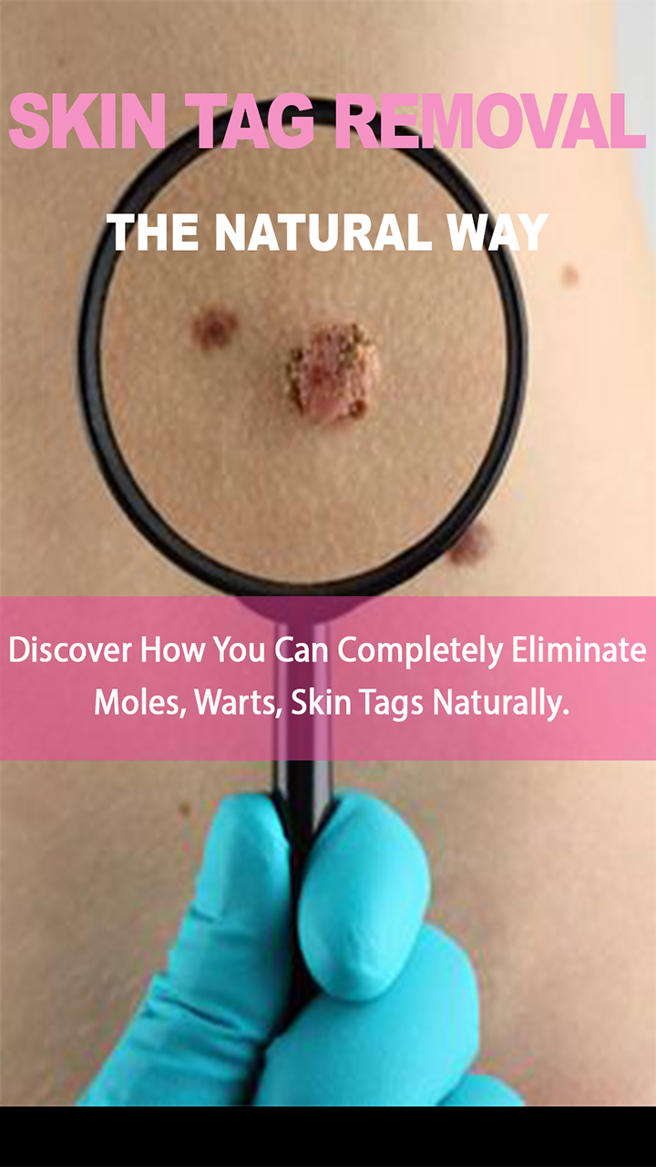 Skin Tag Removal : Discover How You Can Completely Eliminate Moles, Warts, Skin Tags Naturally