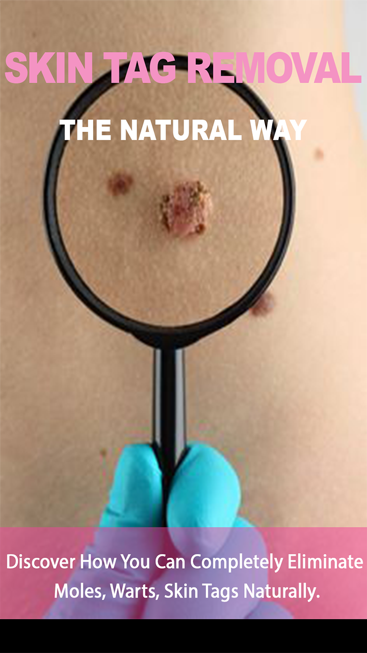 Skin Tag Removal : Discover How You Can Completely Eliminate Moles, Warts, Skin Tags Naturally