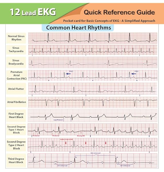 Ekg Pocket Card Harilal Nair Dnp Aprn 9781941004067 Amazon Com Books