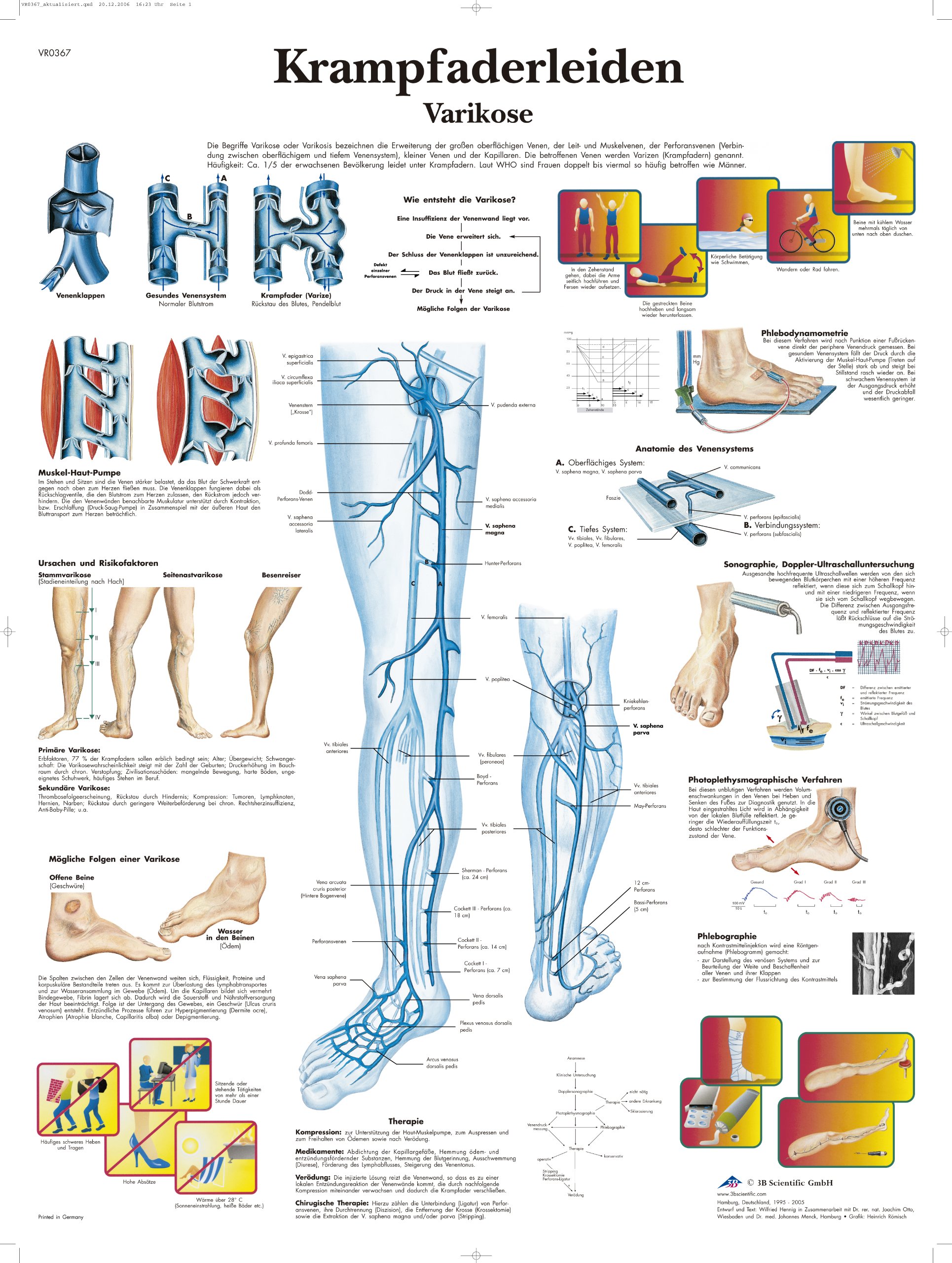 3B Scientific Chart Laminated Varicosis Varicosis, 1
