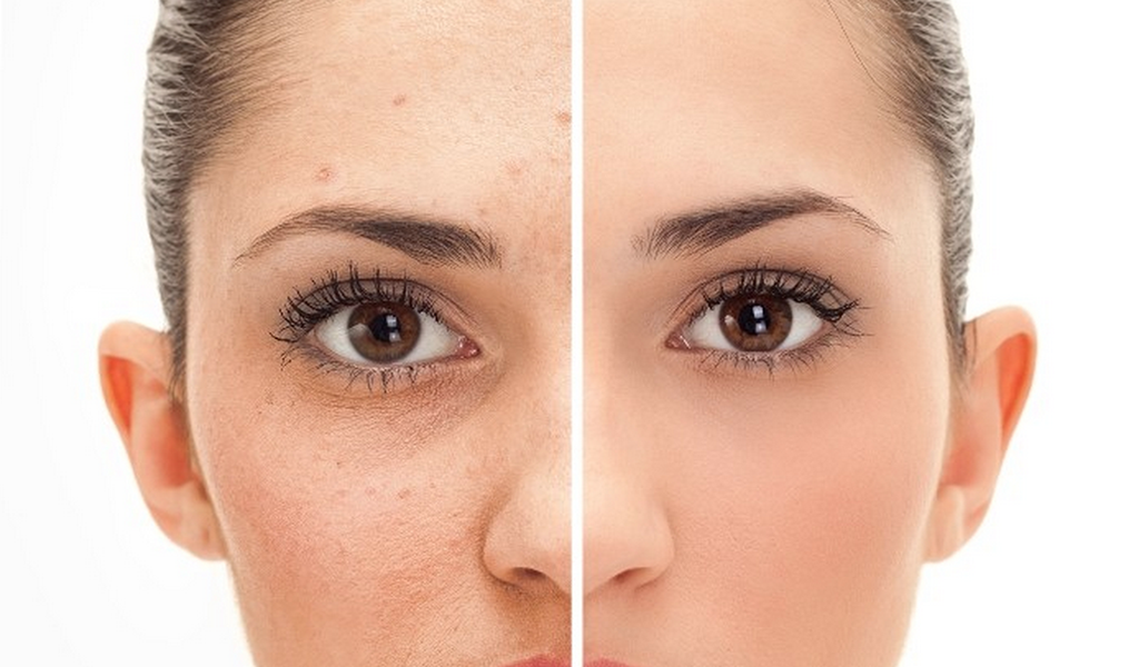 How To Get Rid Of Acne : Quick and Easy Acne Elimination - Proven Remedy For Clear, Acne Free Skin That Works Quickly, Safely And Permanently! - Thumbnail 4