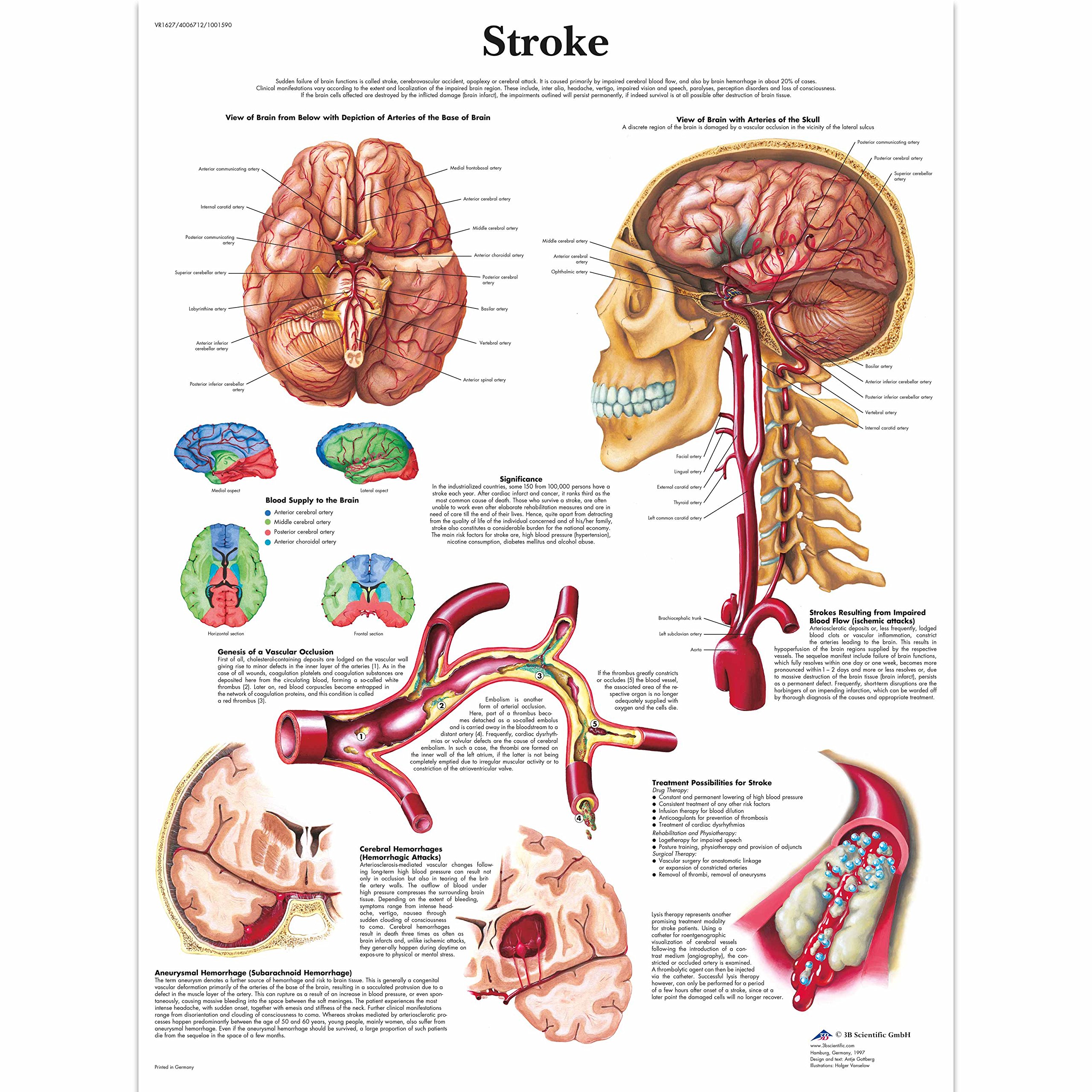 3B Scientific Human Anatomy - Stroke Chart, Paper Version