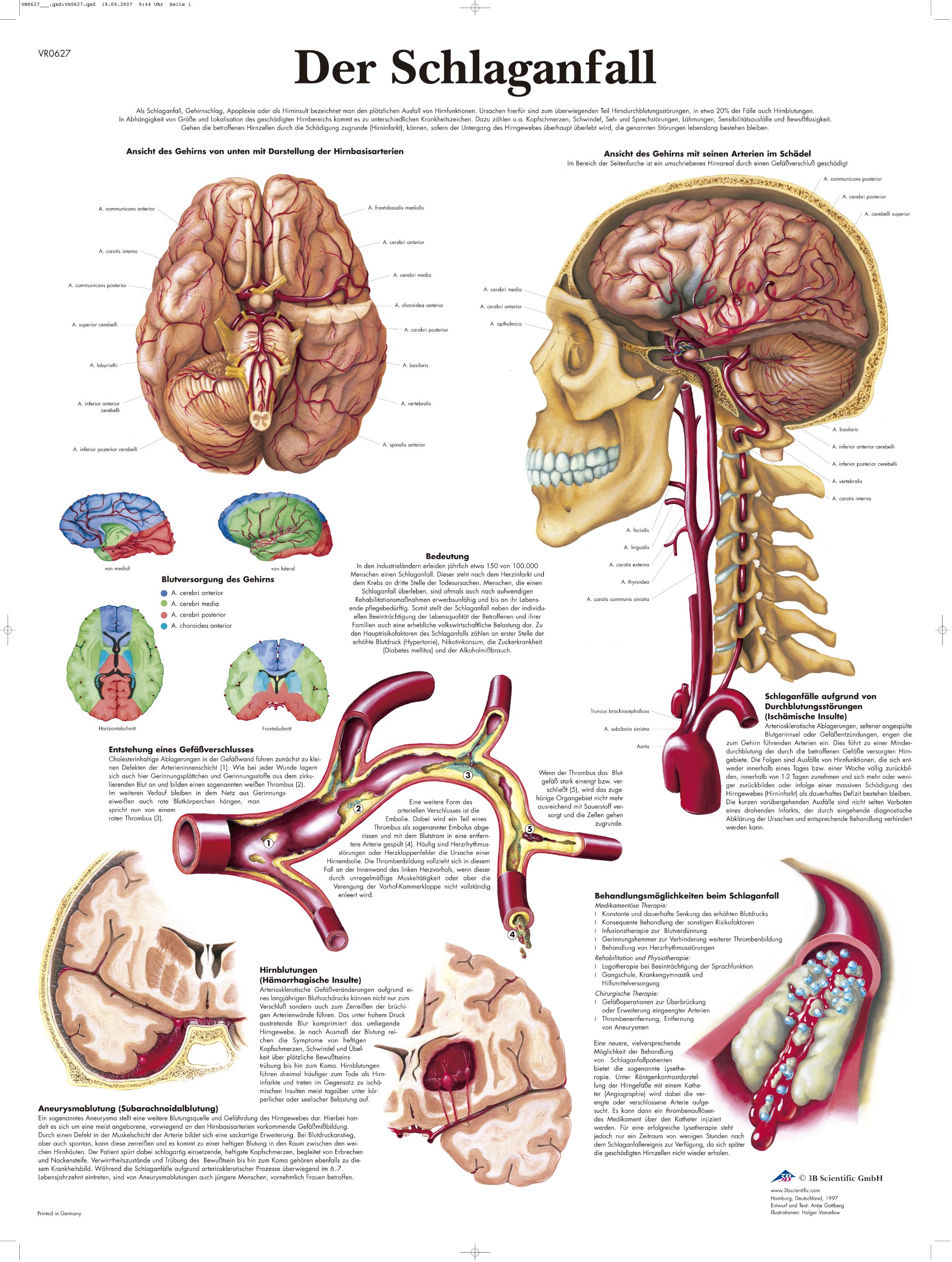 3B Scientific Chart The Stroke, 1