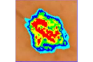 Skin Mole Analysis
