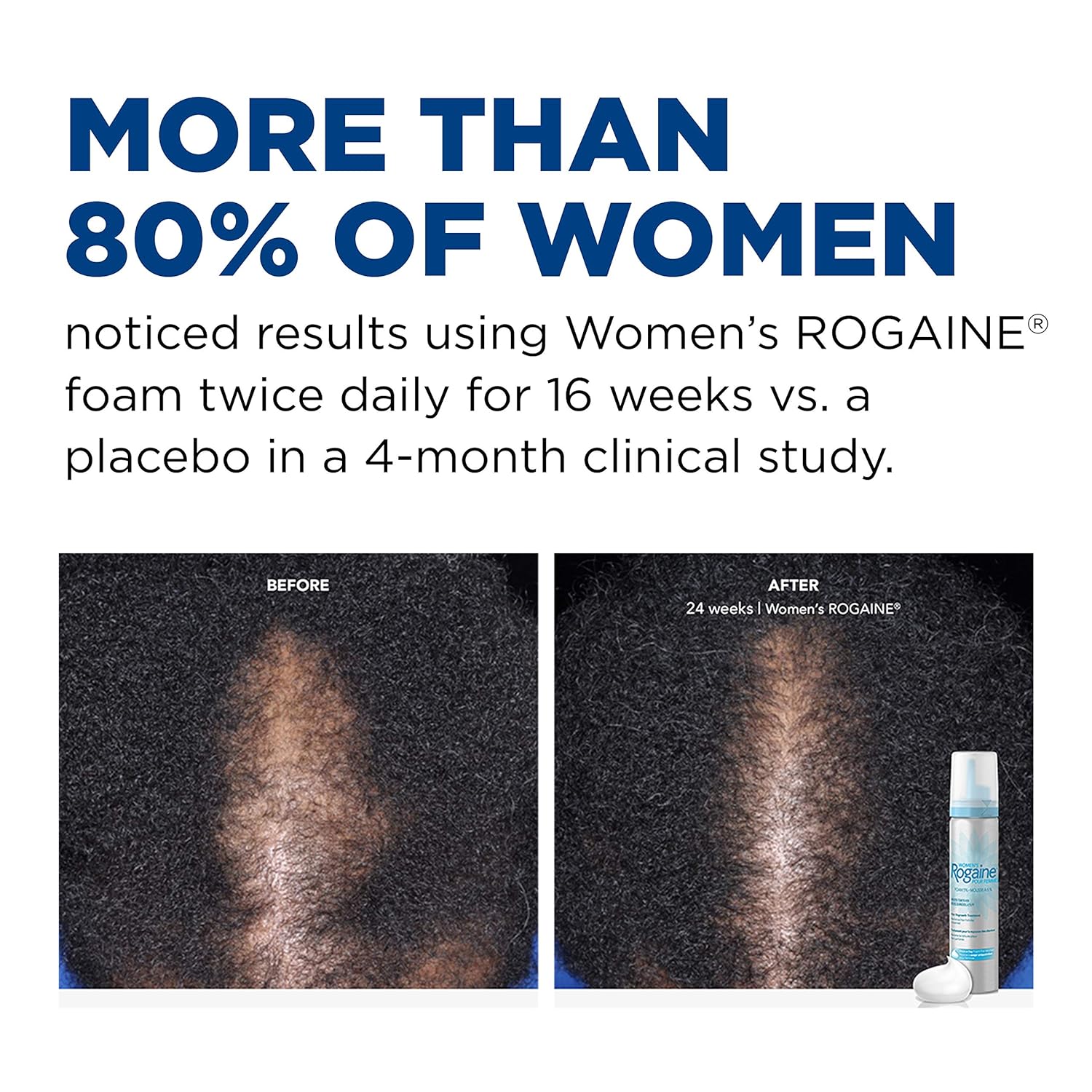 Women's Rogaine 5% Minoxidil Foam for Hair Thinning and Loss, Topical Treatment for Women's Hair Regrowth, 2-Month Supply : Beauty