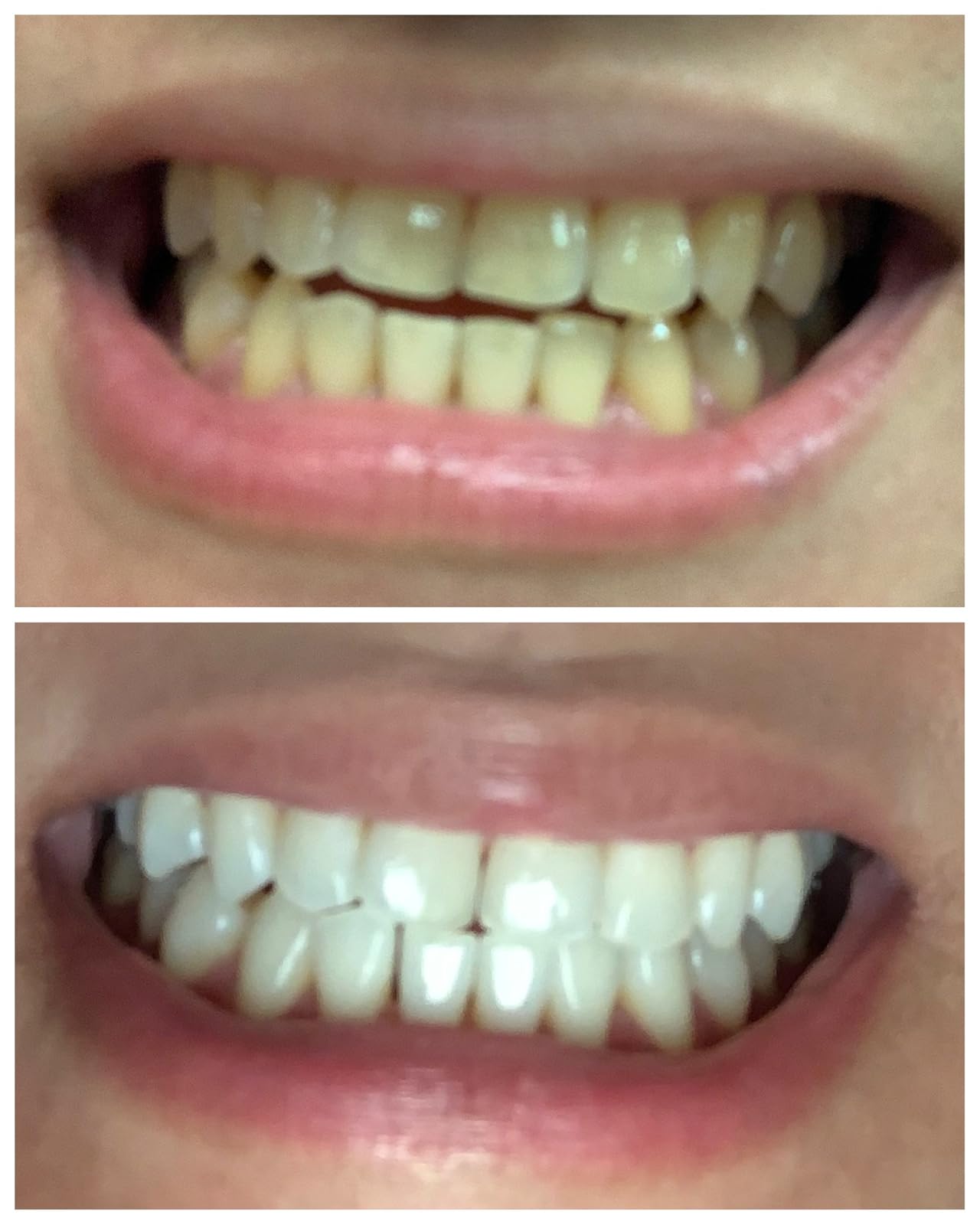 11 Best Crest Whitening Strips for Sensitive Teeth [99 Review]