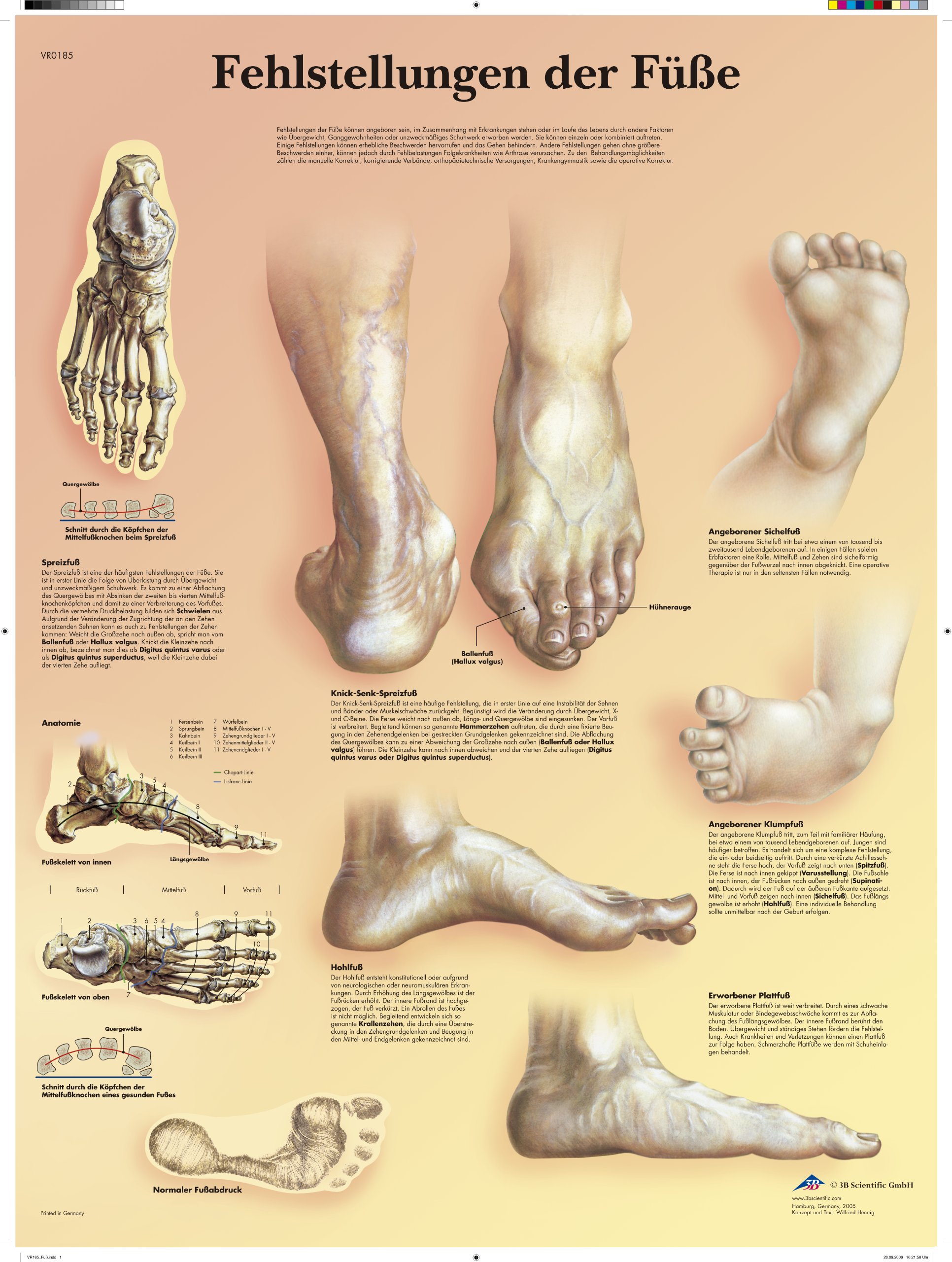 3B Scientific VR0185UU Misalignment of the Feet Chart, 1