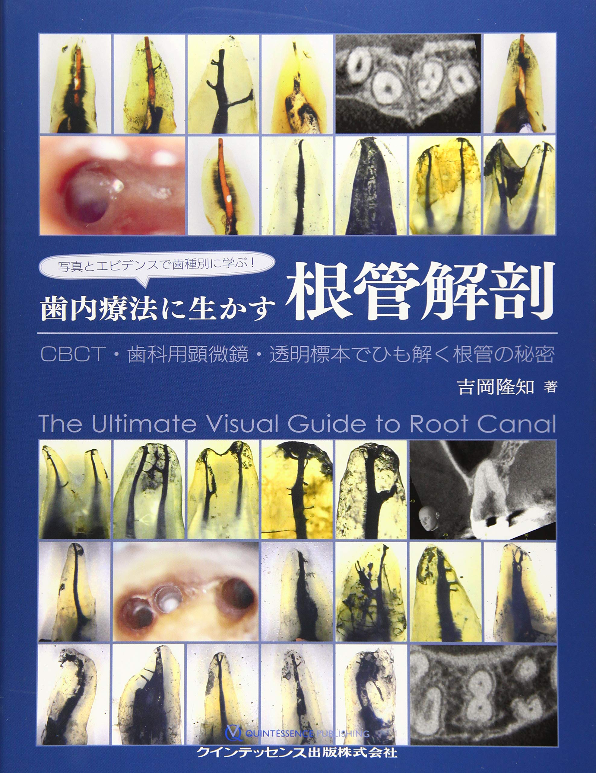 写真とエビデンスで歯種別に学ぶ 歯内療法に生かす根管解剖 吉岡 隆知 本 通販 Amazon