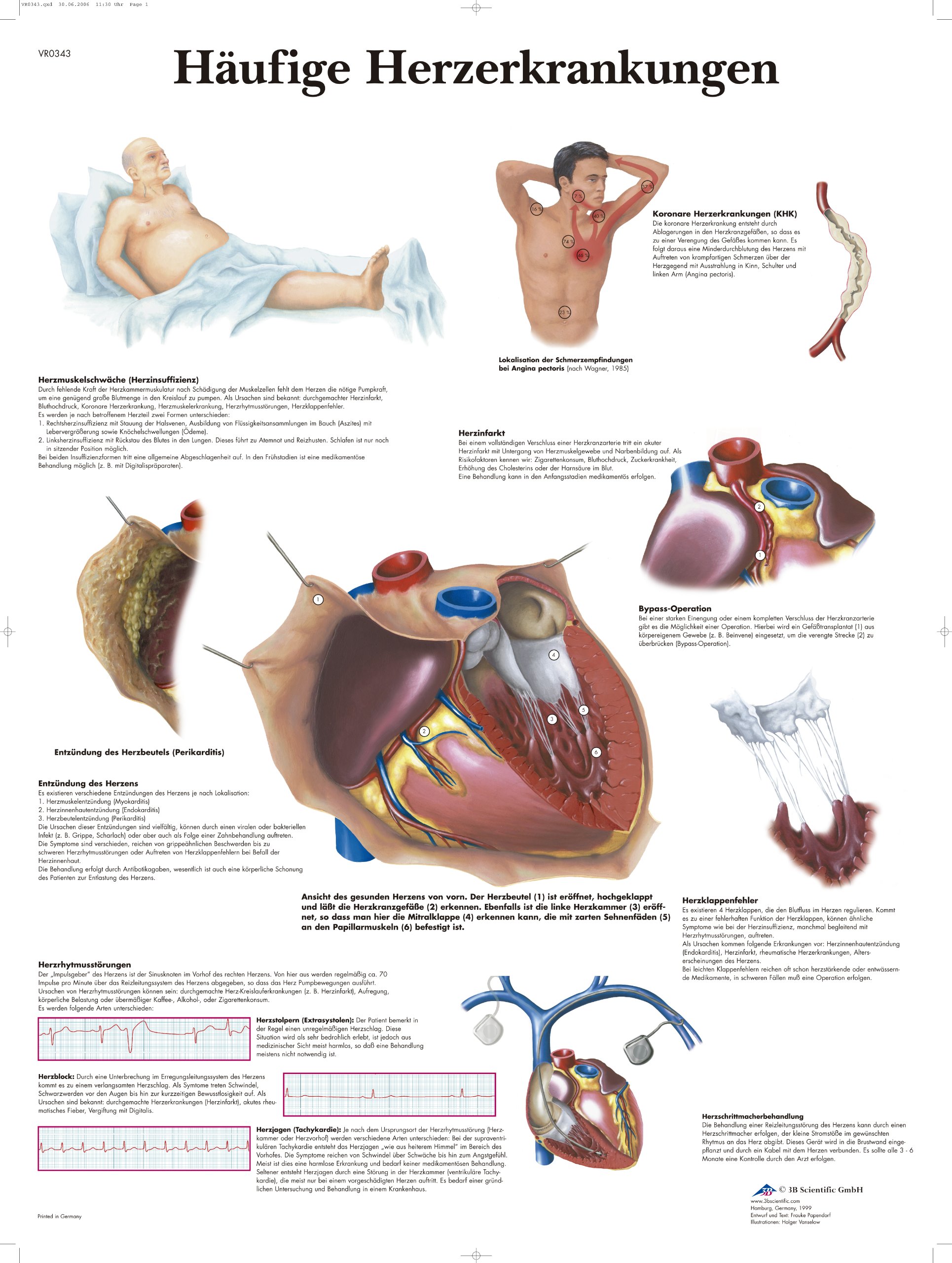 3B Scientific Anatomical Chart 'Häufige Herzerkrankungen' ('Common Heart Diseases'), German Language