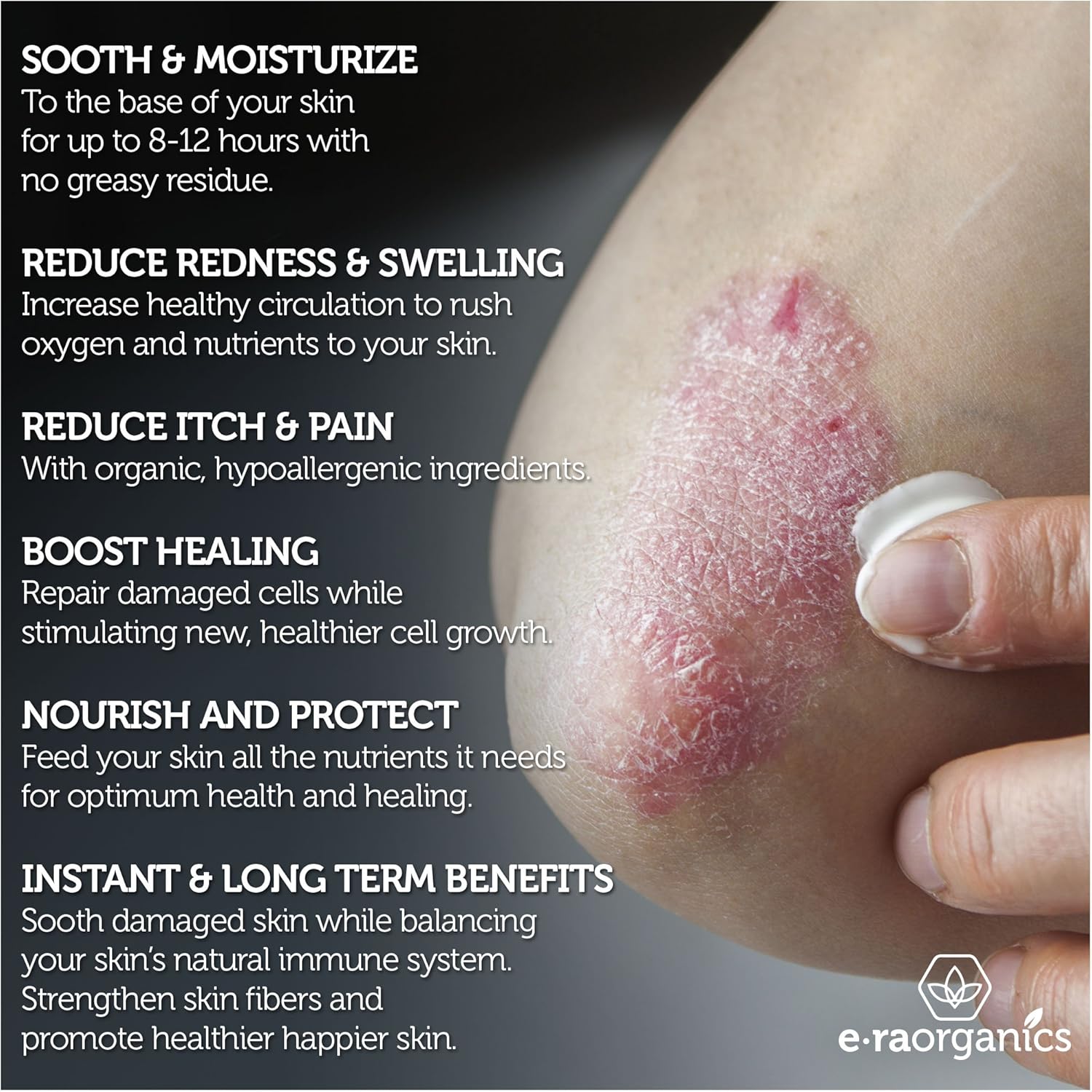 Era Organics Eczema, Psoriasis & Dermatitis Cream - Advanced 15-in-1 Non-Greasy Soothing Moisturizer with Aloe Vera, Manuka Honey, Hemp Oil & More. Face & Body Lotion for Dry Itchy Skin Care 4oz: Health & Personal Care