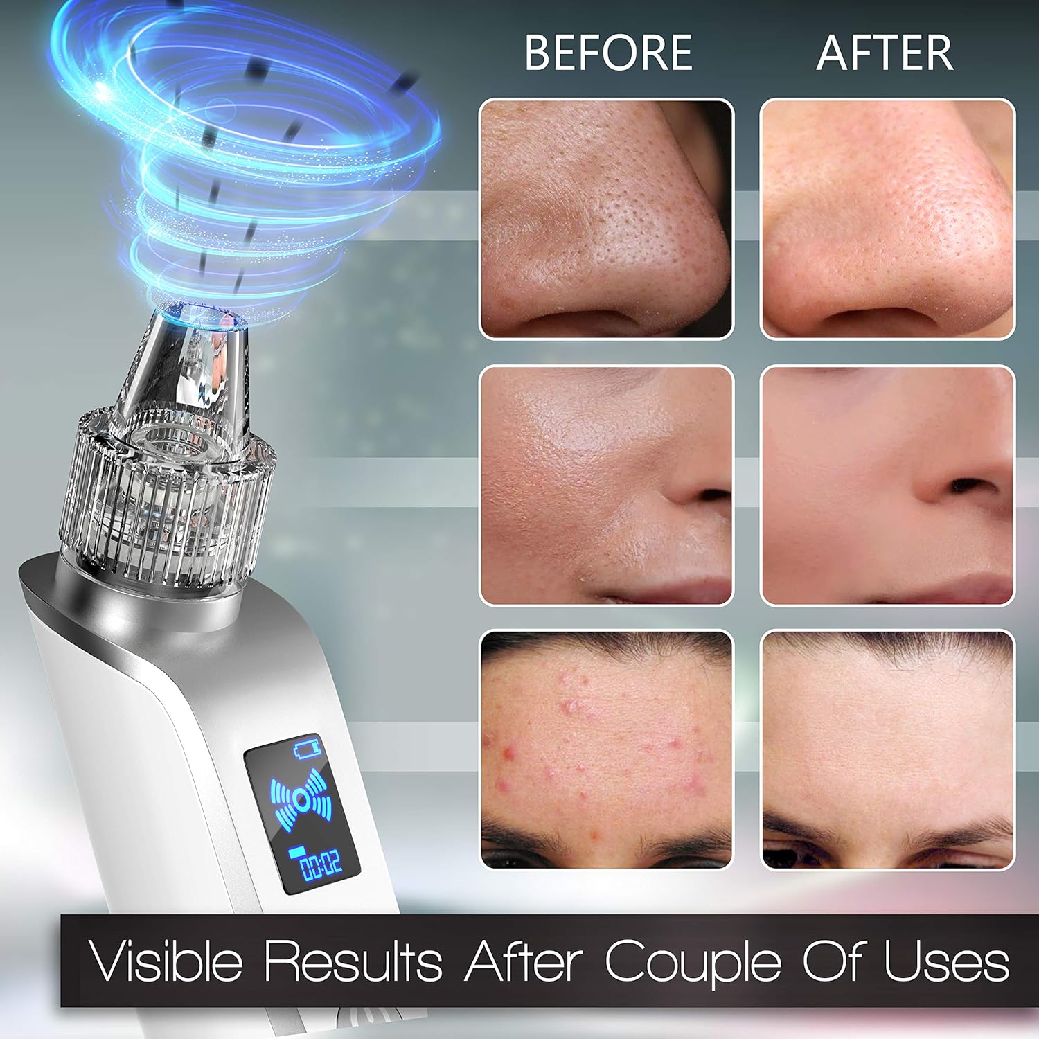 Olrom Blackhead Remover – Electric Vacuum Suction Blackhead Remover w/LED Display – Powerful Acne & Pore Cleanser –– Blackhead Removal Tool –– 5 Suction Heads – Black Heads Extraction for Women & Men: Beauty