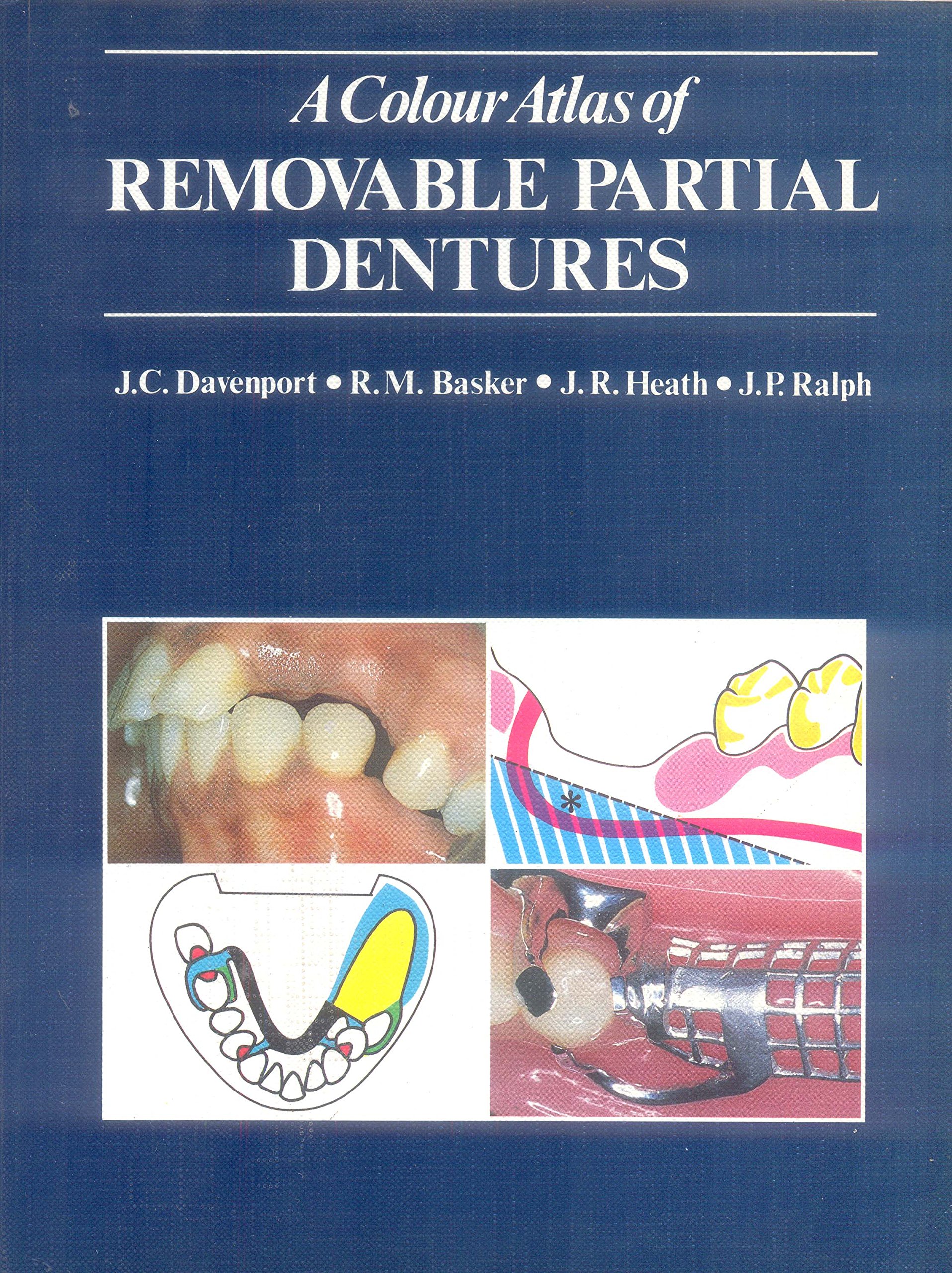 Buy A Colour Atlas Of Removable Partial Dentures Book Online At Low Prices In India A Colour Atlas Of Removable Partial Dentures Reviews Ratings Amazon In Buy A Colour Atlas Of Removable Partial Dentures Book Online At Low Prices In India A Colour Atlas Of Removable Partial Dentures Reviews Ratings Amazon In
