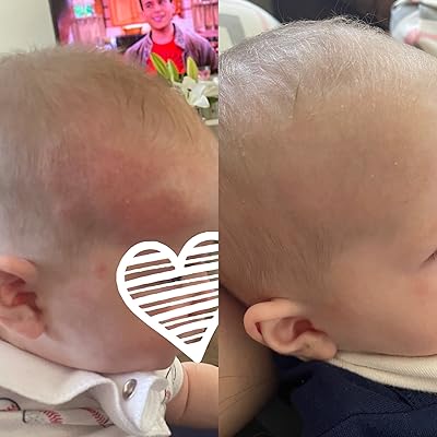 Buy Truelipids Eczema Anti Itch 1 Hydrocortisone Barrier Cream Online In Vietnam B00k8oia