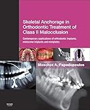 Skeletal Anchorage In Orthodontic Treatment Of Class Ii Malocclusion Contemporary Applications Of Orthodontic Implants Miniscrew Implantsand Mini Plates