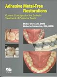 Adhesive Metalfree Restorations Current Concepts For The Esthetic Treatment Of Posterior Teeth