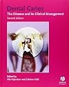 Dental Caries: The Disease and Its Clinical Management