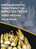 Orthodontic Treatment Of Impacted Teeth