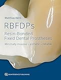 Rbfdps Resinbonded Fixed Dental Prostheses Minimally Invasive Esthetic Reliable
