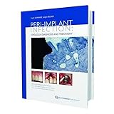 Periimplant Infection Etiology Diagnosis And Treatment