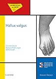 Hallux Valgus Mises Au Point De Lafcp