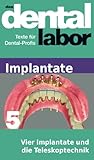 Vier Implantate Und Die Teleskoptechnik Das Dental Labor Fachtexte 25 German Edition