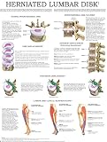 Herniated Lumbar Disk Quick Reference Chart Full Illustrated English Edition