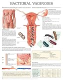 Bacterial Vaginosis E Chart Full Illustrated