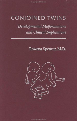 Rare Feat The Science Of Mobility In Conjoined Twins - ac6yr6i