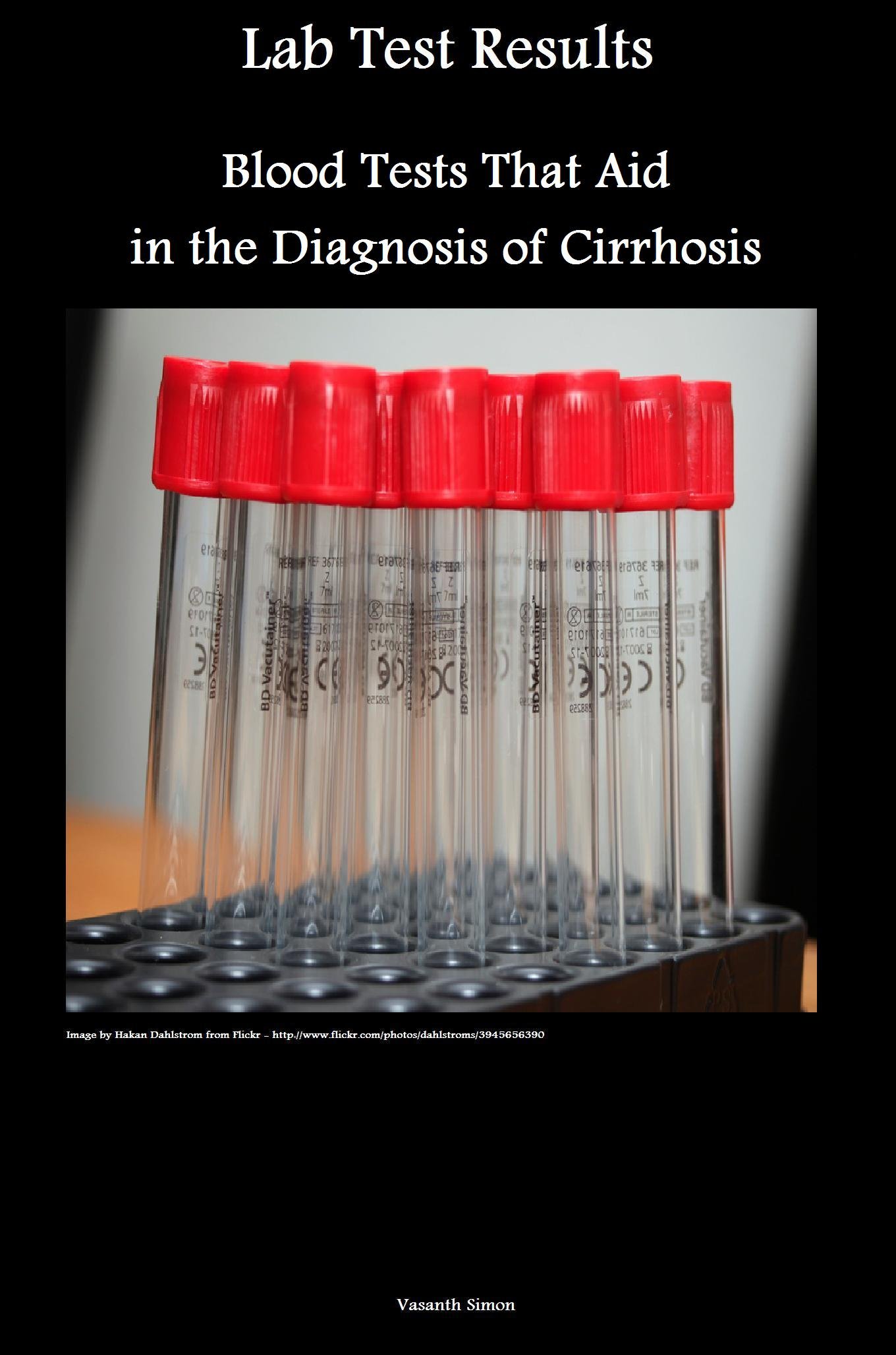 Lab Test Results Blood Tests That Aid in the Diagnosis of Cirrhosis