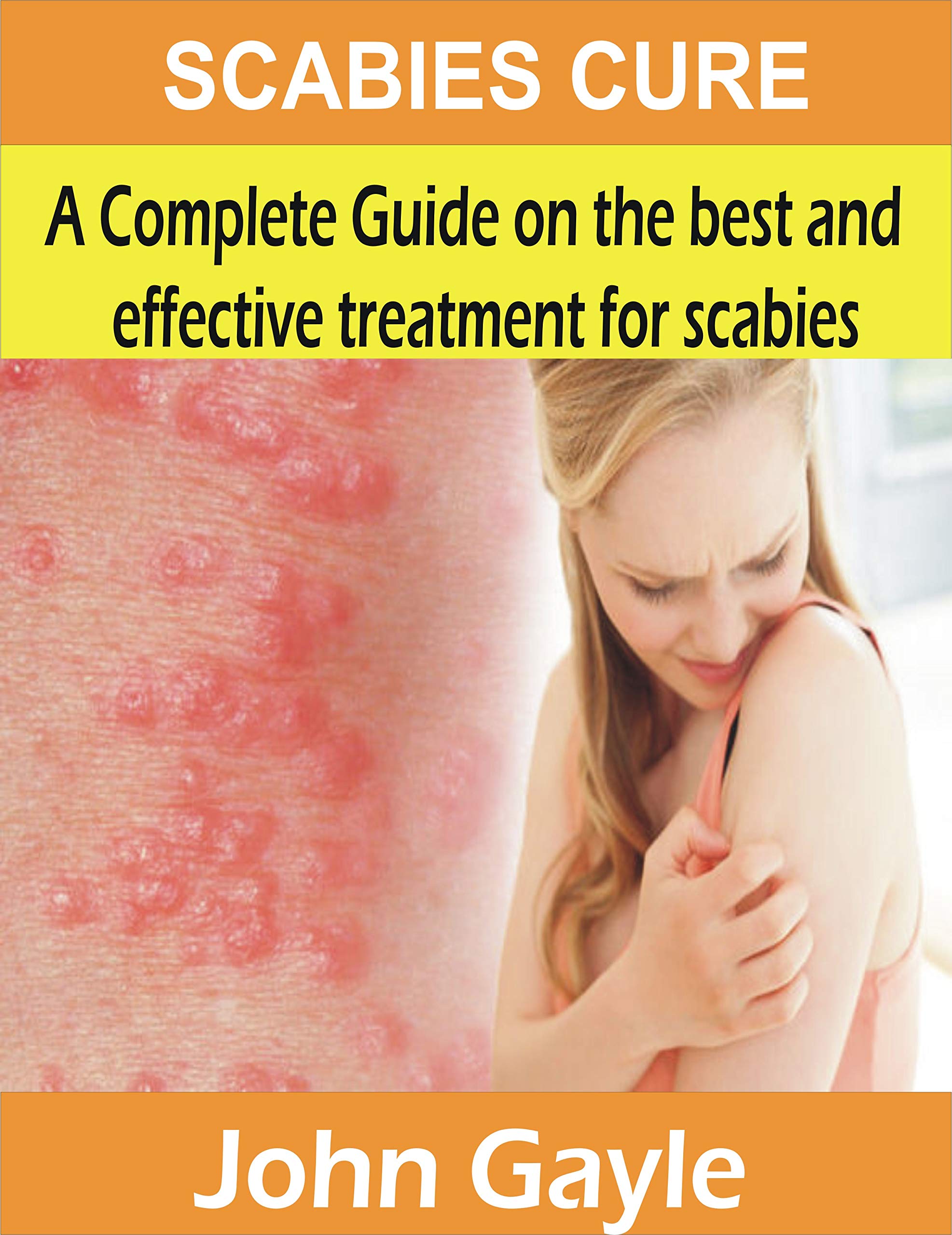 SCABIES CURE A Complete Guide On The Best And Effective Treatment For 