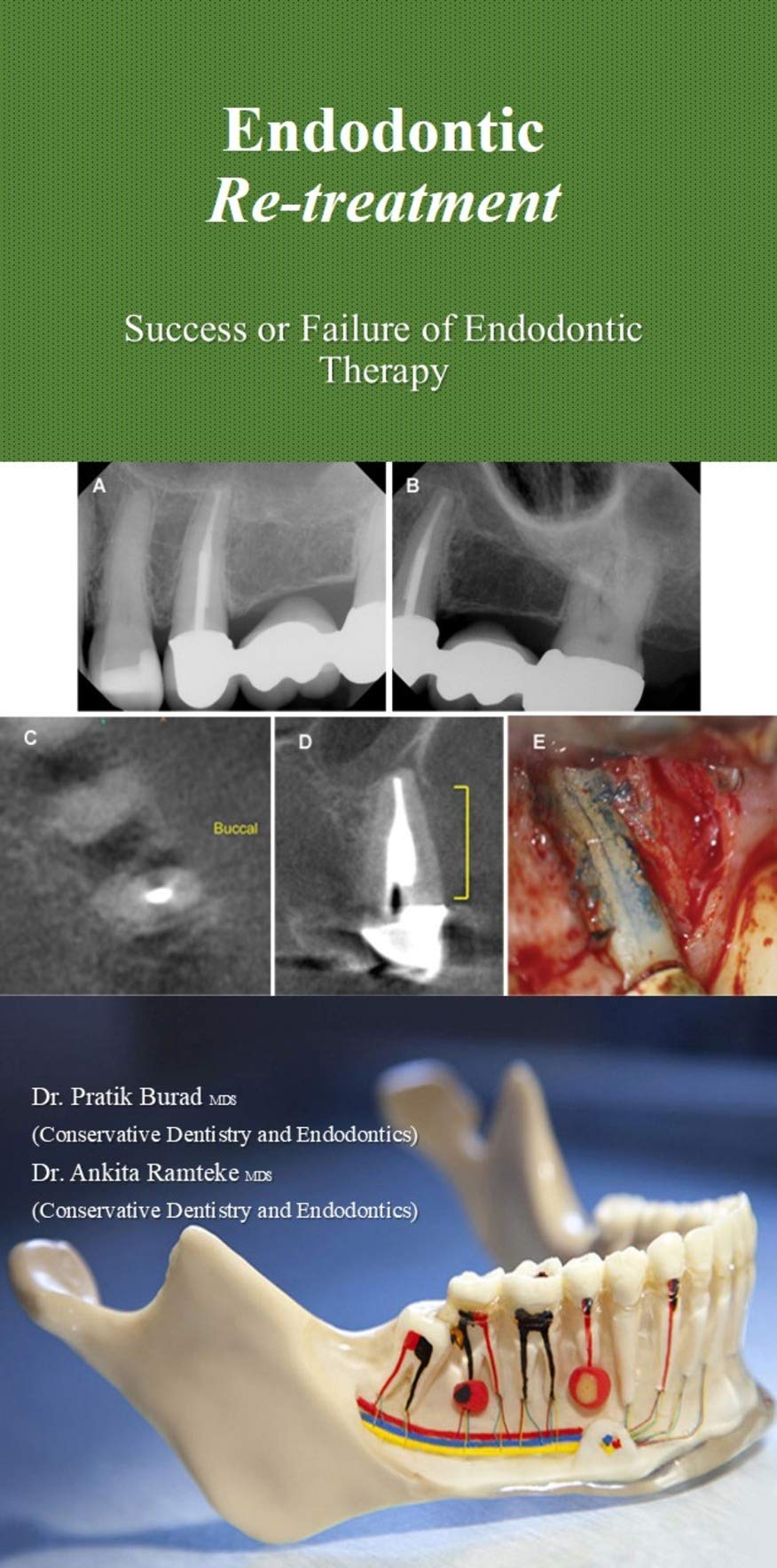 Endodontic Retreatment Success or Failure of Endodontic Therapy by Dr
