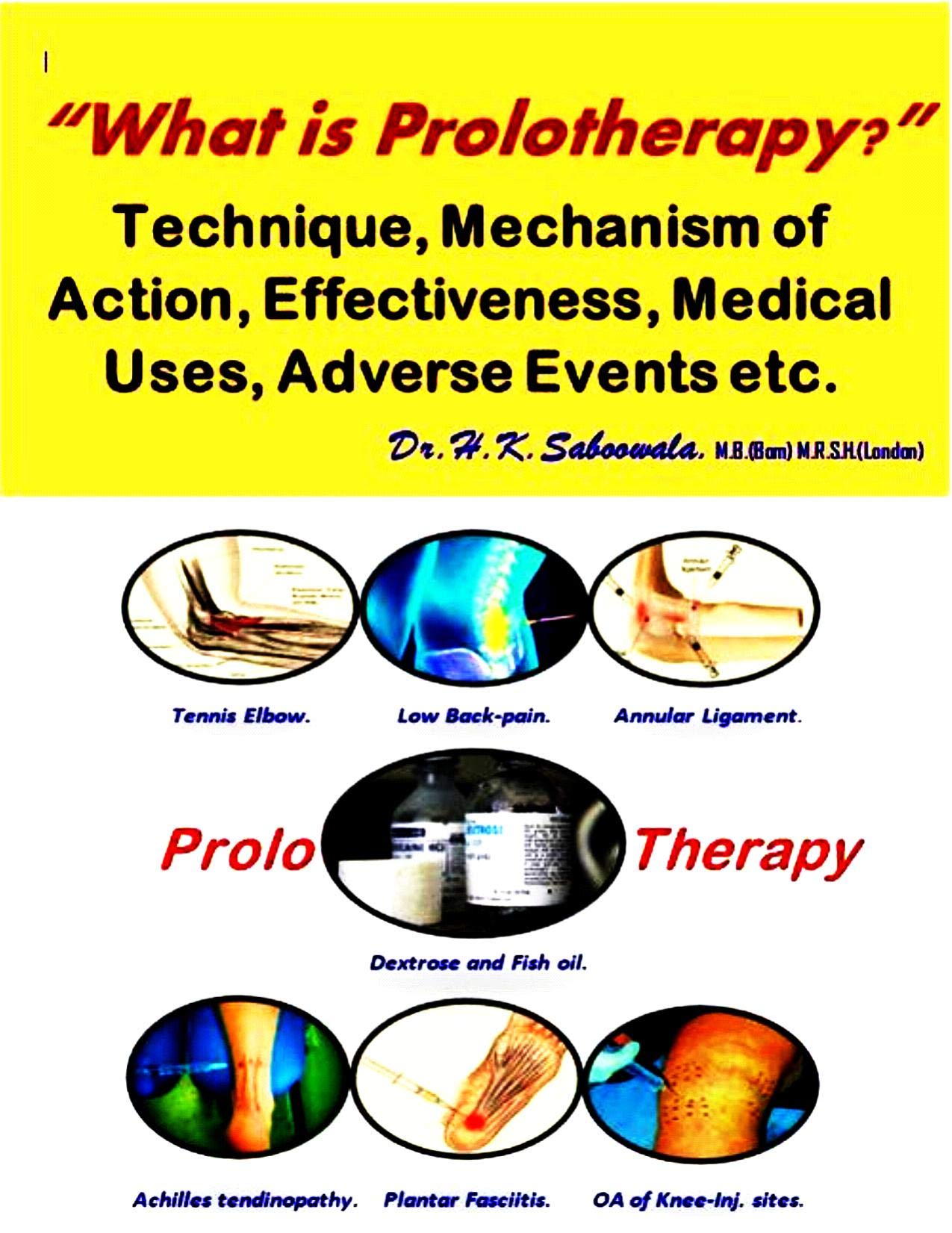 “What is Prolotherapy?” Technique, Mechanism of Action, Effectiveness