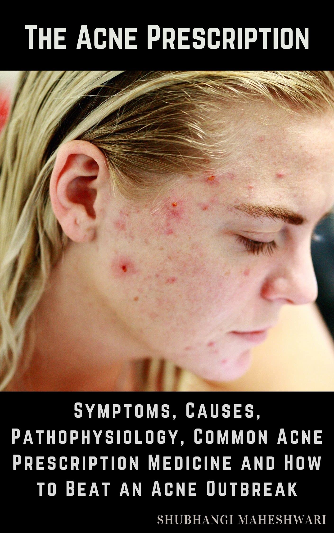 The Acne Prescription Symptoms, Causes, Pathophysiology, Common Acne