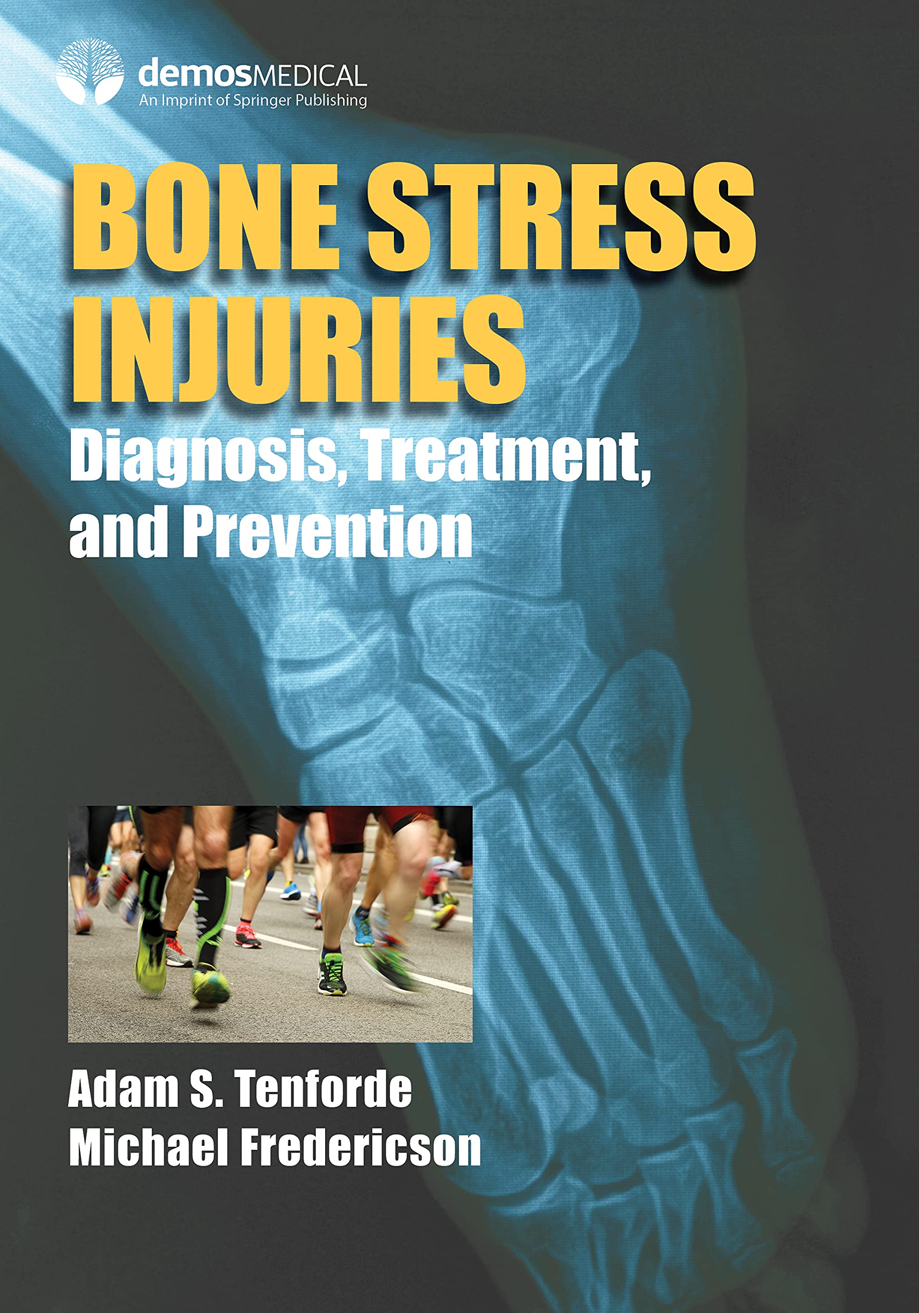 Bone Stress Injuries: Diagnosis, Treatment, and Prevention by Adam S ...
