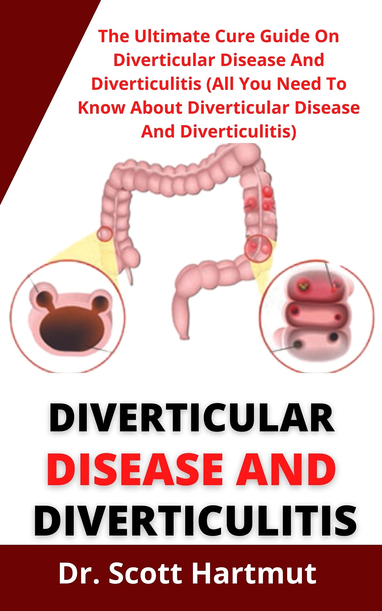 Diverticular Disease And Diverticulitis : The Ultimate Cure Guide On