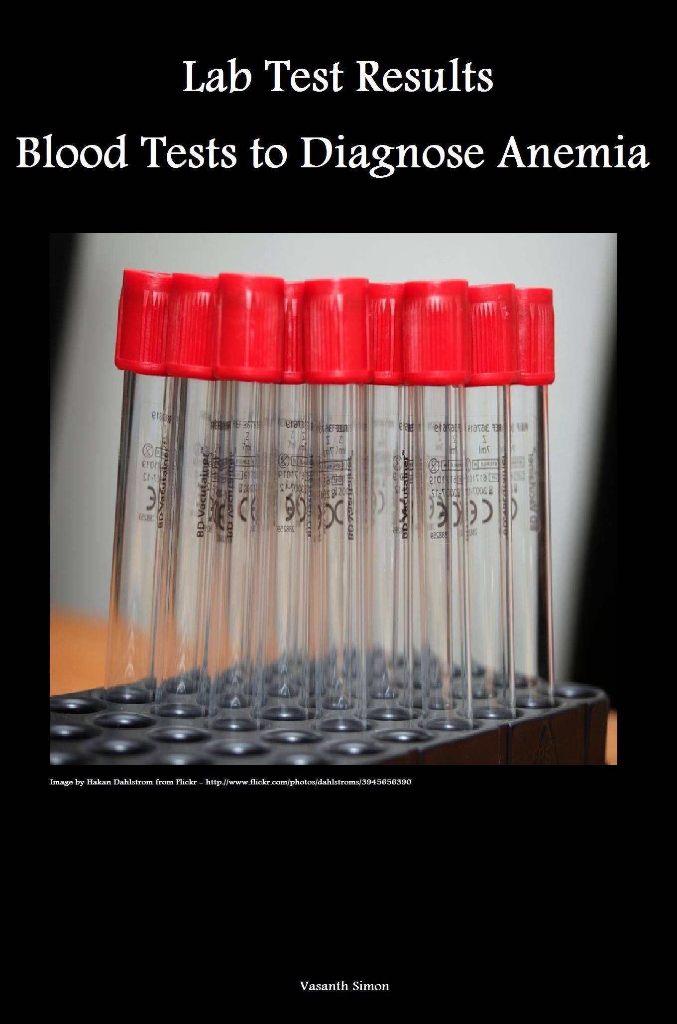 Lab Test Results Blood Tests to Diagnose Anemia by Vasanth Simon