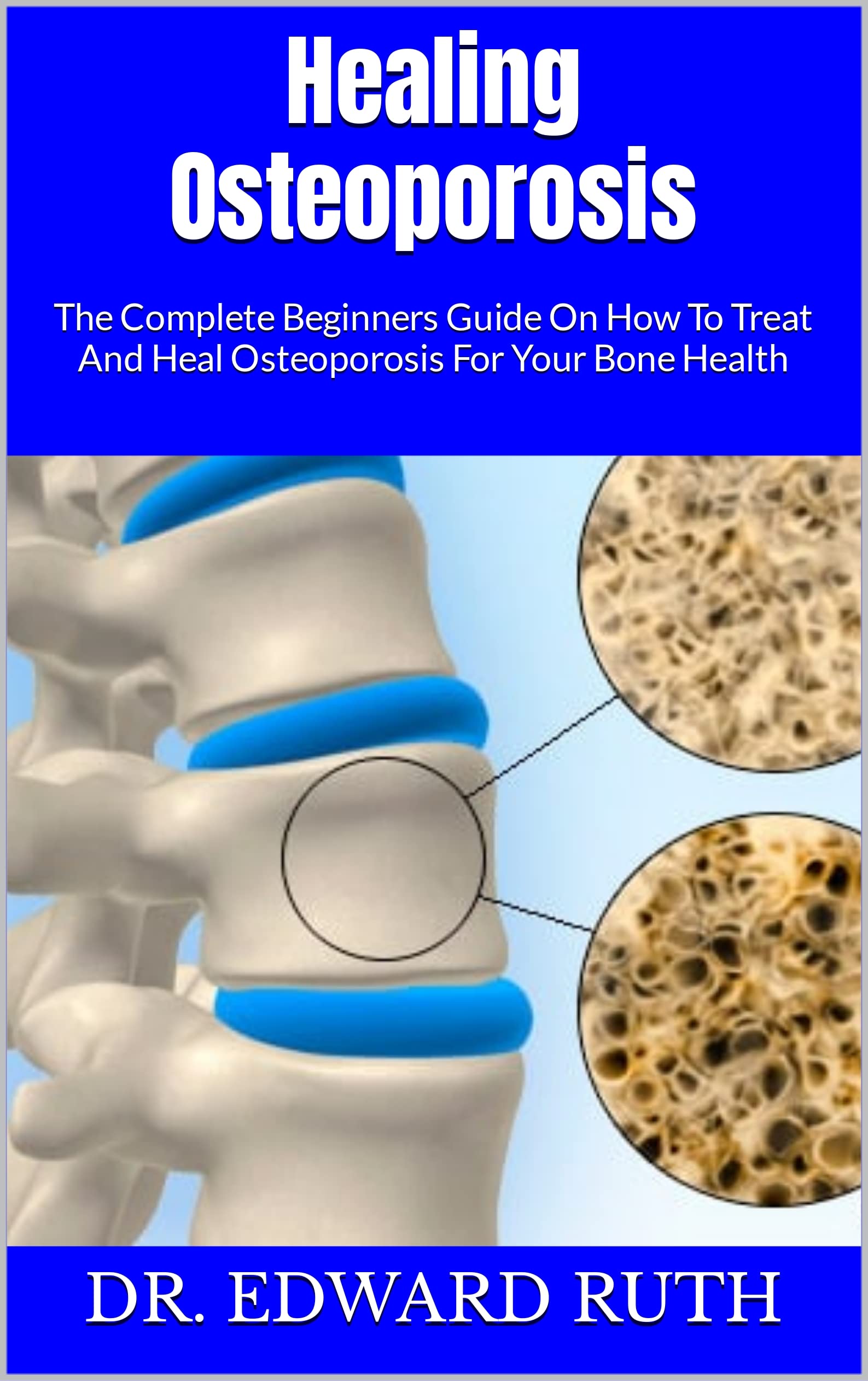 Healing Osteoporosis The Complete Beginners Guide On How To Treat And