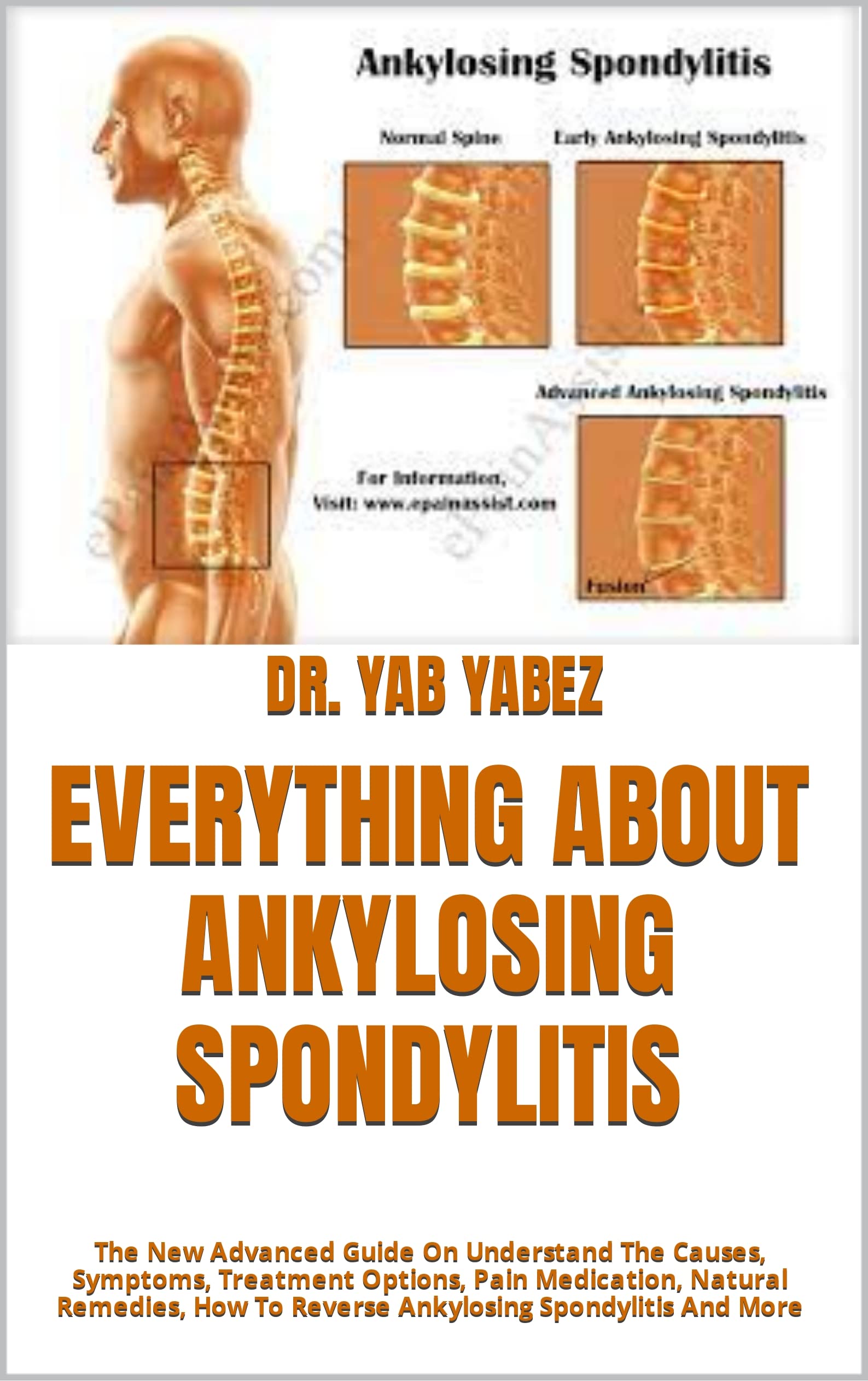 EVERYTHING ABOUT ANKYLOSING SPONDYLITIS The New Advanced Guide On