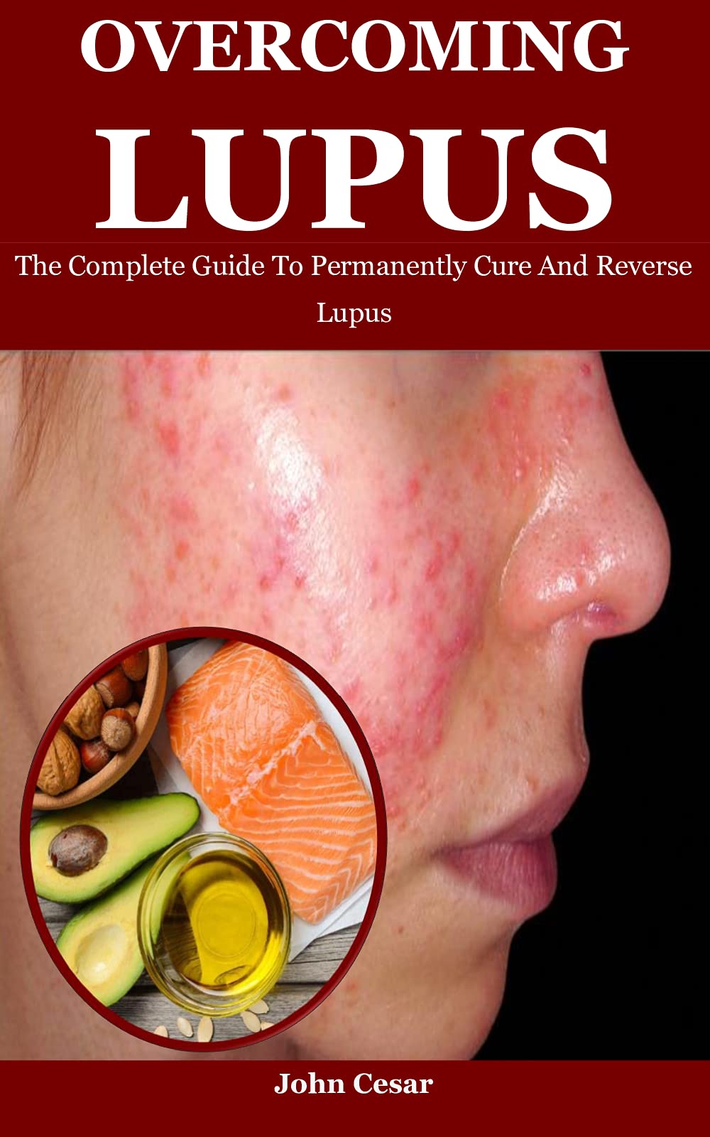 Lupus The Complete Guide To Permanently Cure And Reverse
