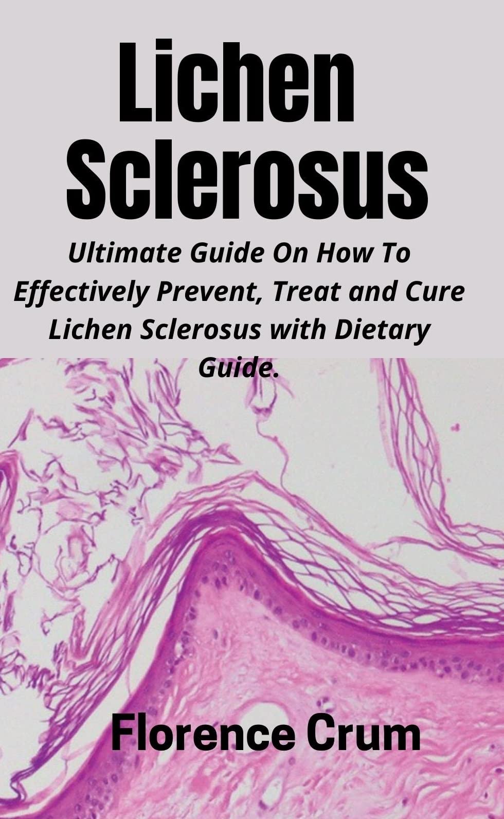 Lichen Sclerosus Ultimate Guide On How To Effectively Prevent, Treat