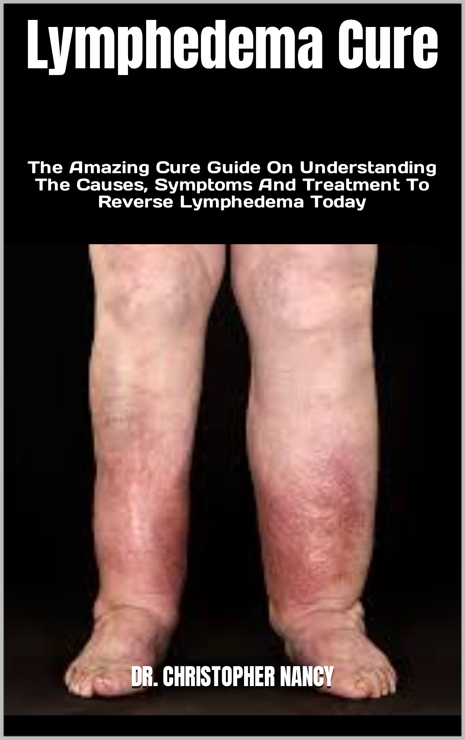 Lymphedema Cure The Amazing Cure Guide On Understanding The Causes