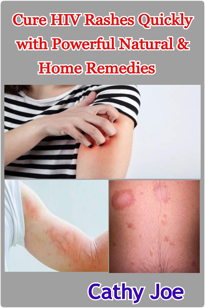 Cure HIV Rashes Quickly with Powerful Natural & Home Remedies by Cathy