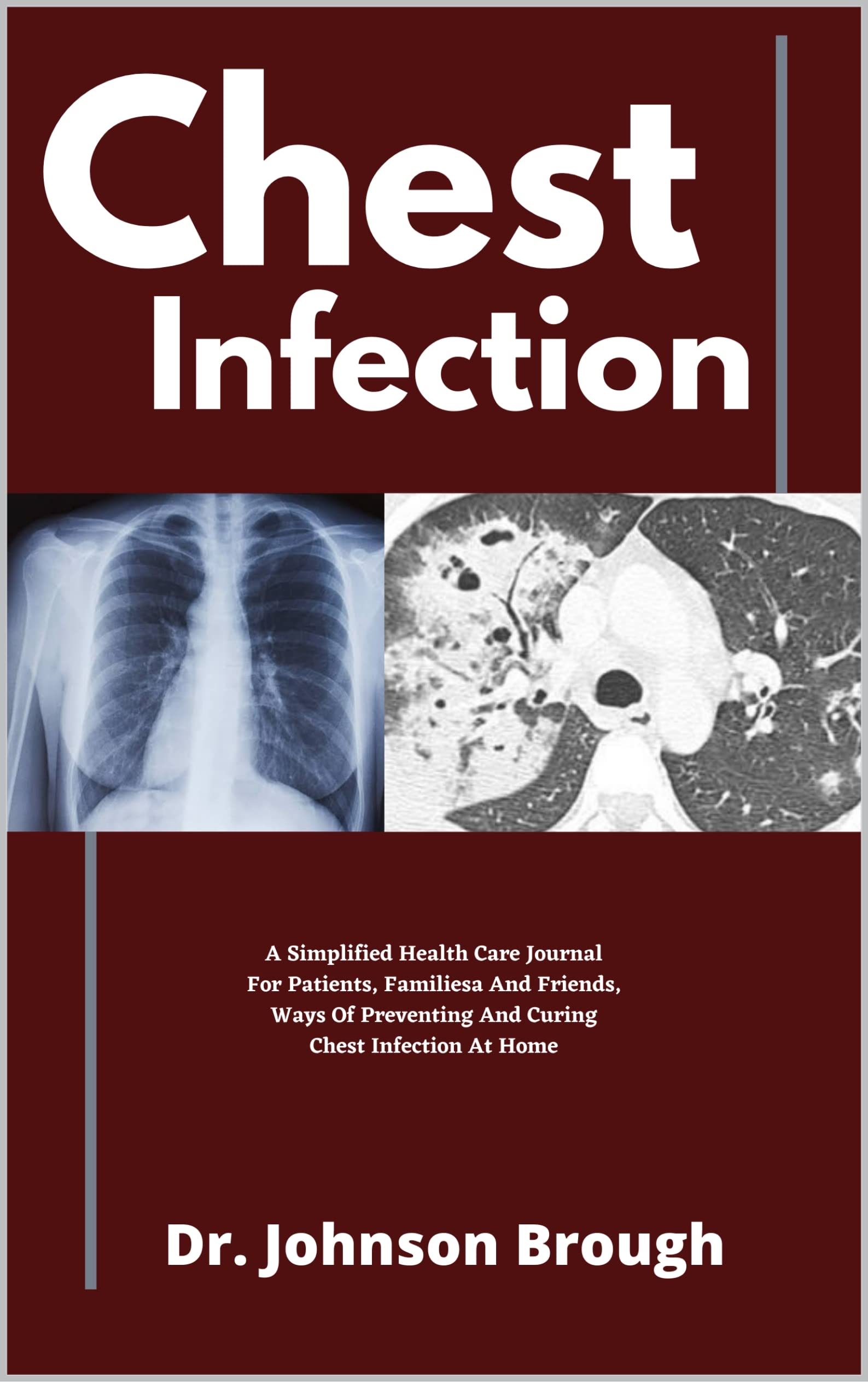 Chest Infection A Simplified Health Care Journal For Patients