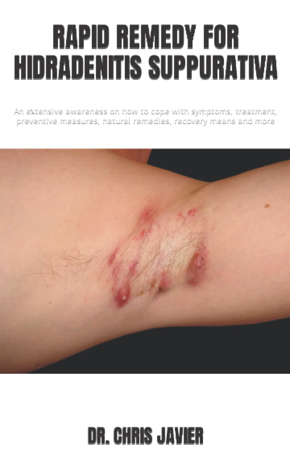 RAPID REMEDY FOR SUPPURATIVA An Extensive Awareness On How To Cope With Symptoms 61748524