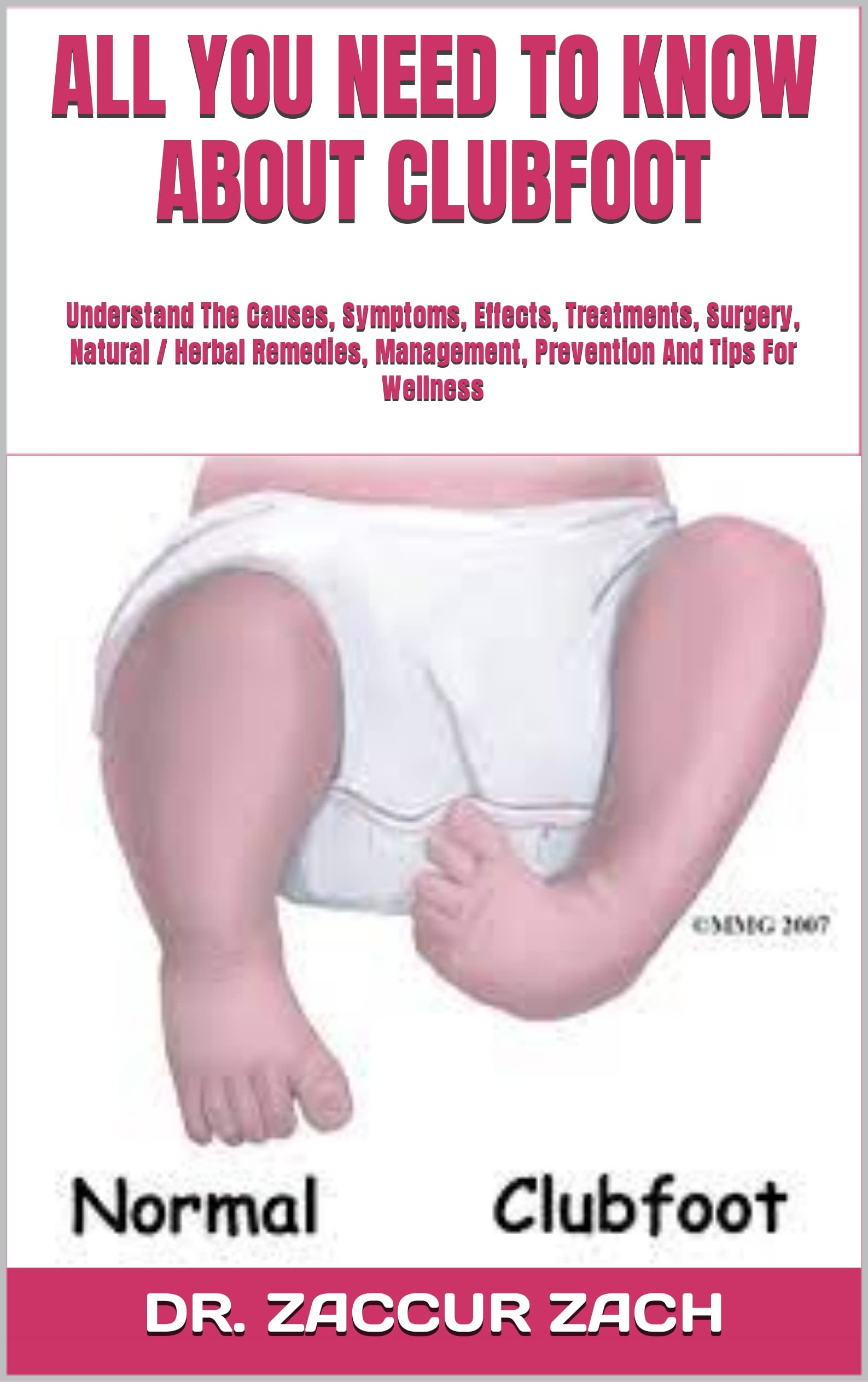 Clubfoot Symptoms, Causes, – Clubfoot: Symptoms and Causes – XANH